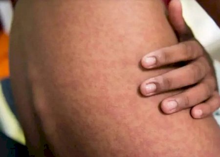 Chikungunya avança no Estado e registra 1ª morte em Bonito; MS já soma seis óbitos